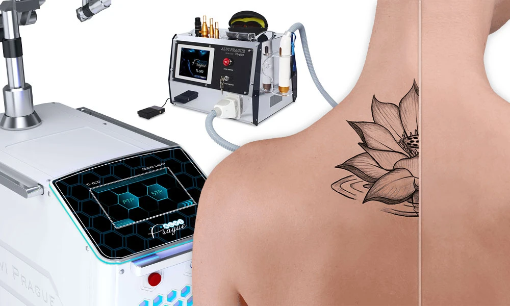 Cómo eliminar un tatuaje