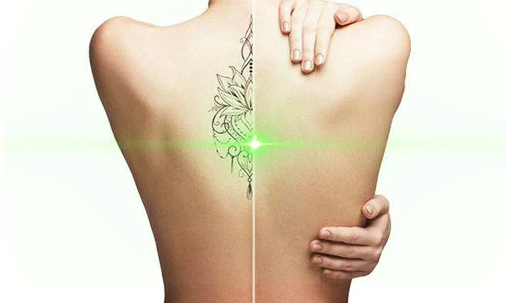 Métodos de eliminación de tatuajes