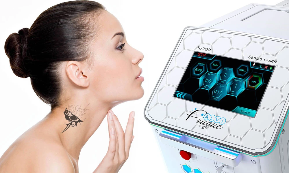 Eliminación de tatuajes con láser de picosegundos