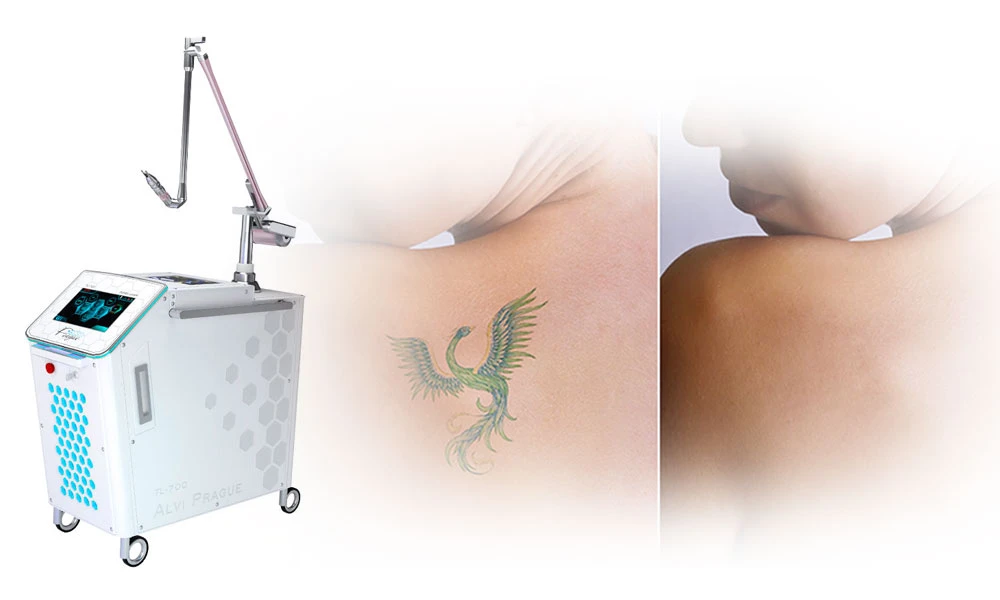 De qué color se pueden eliminar los tatuajes con un láser de neodimio de picosegundos