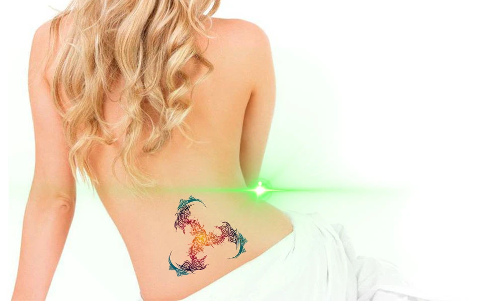 Un láser de picosegundos eliminará por completo un tatuaje