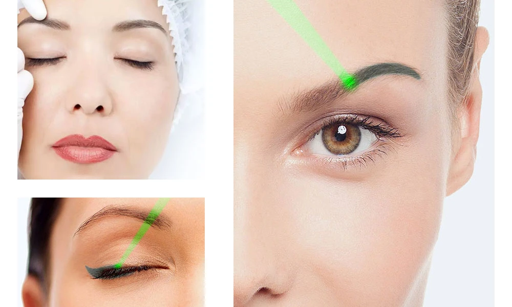 Cuáles son las contraindicaciones para la eliminación de tatuajes con láser