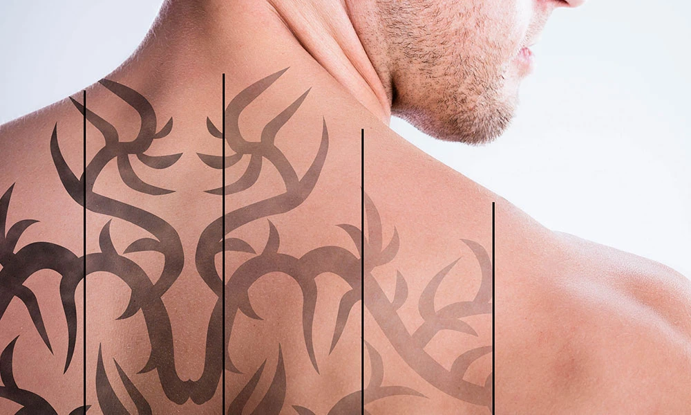 Qué puede esperar después de la eliminación de tatuajes con láser