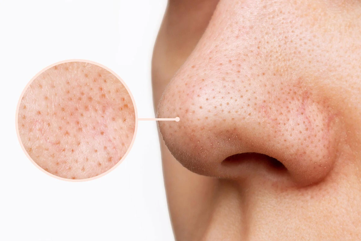 qué microneedling elegir para las marcas de acné, los poros y la textura irregular