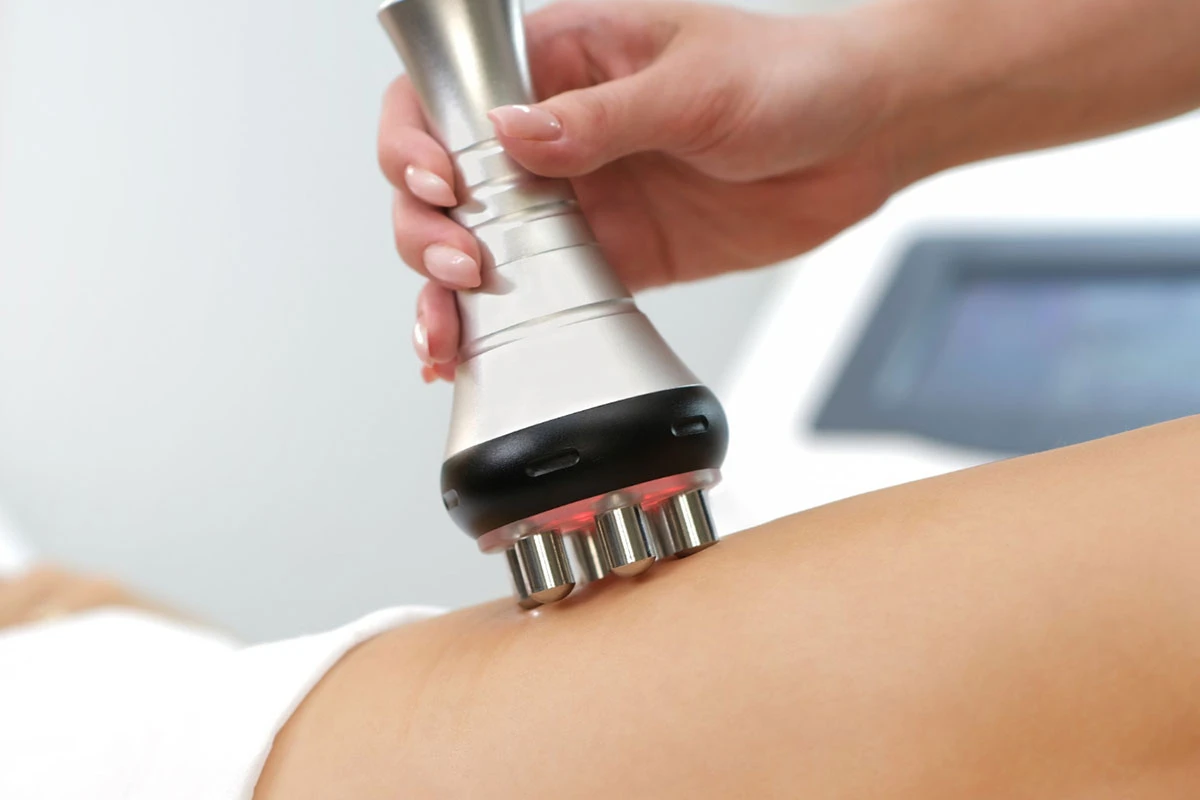 cómo presentar eficazmente el procedimiento de rf-lifting a los clientes