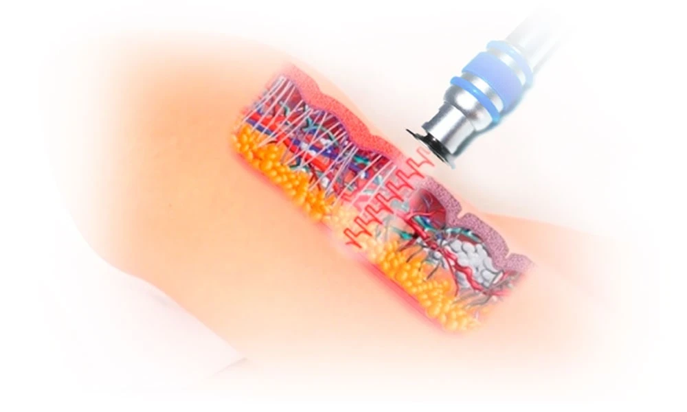 Cómo se realiza la terapia por ondas de choque